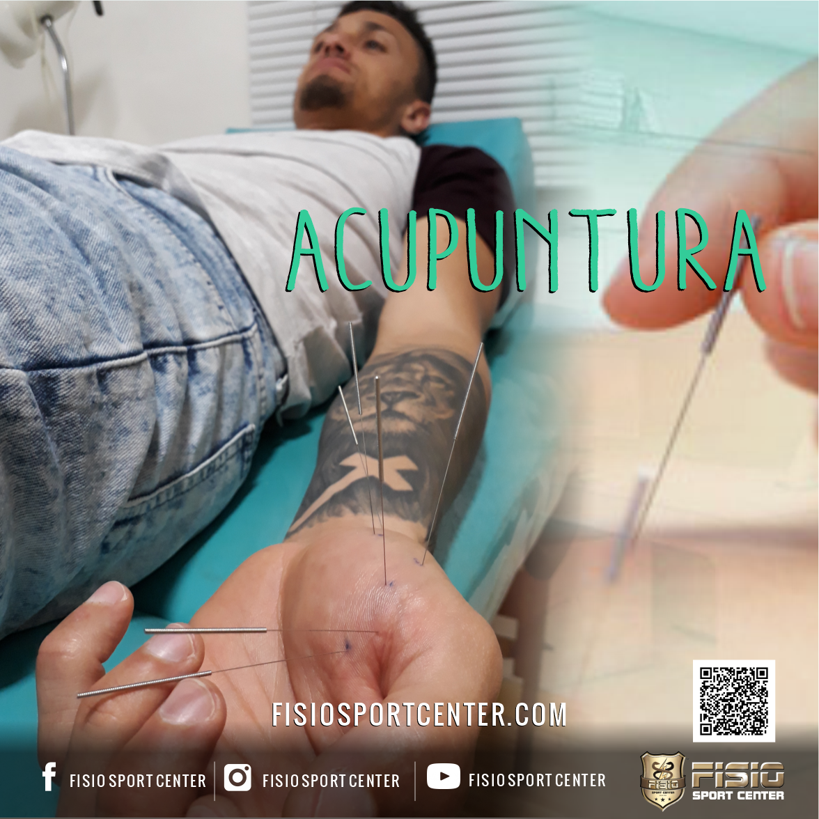 Acupuntura | Fisio Sport Center